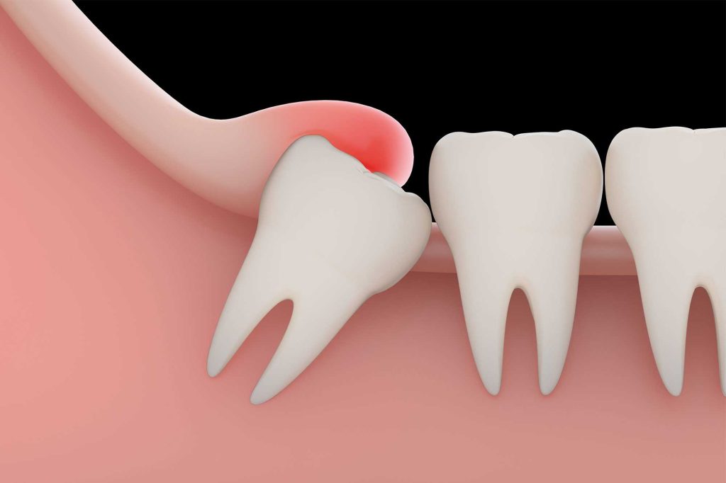 3rd molar surgery image