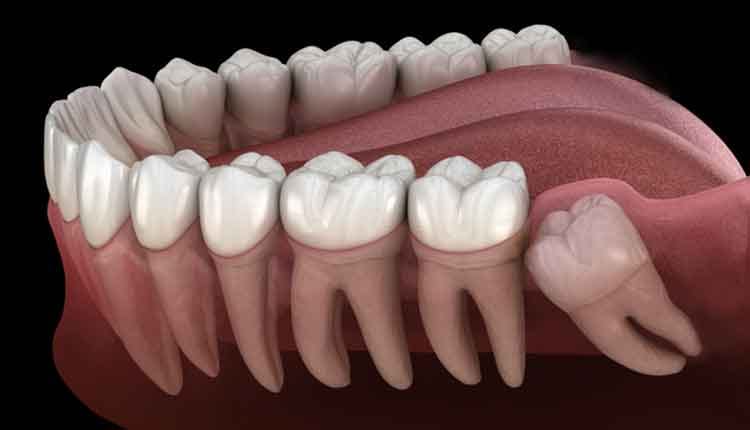 3rd molar surgery